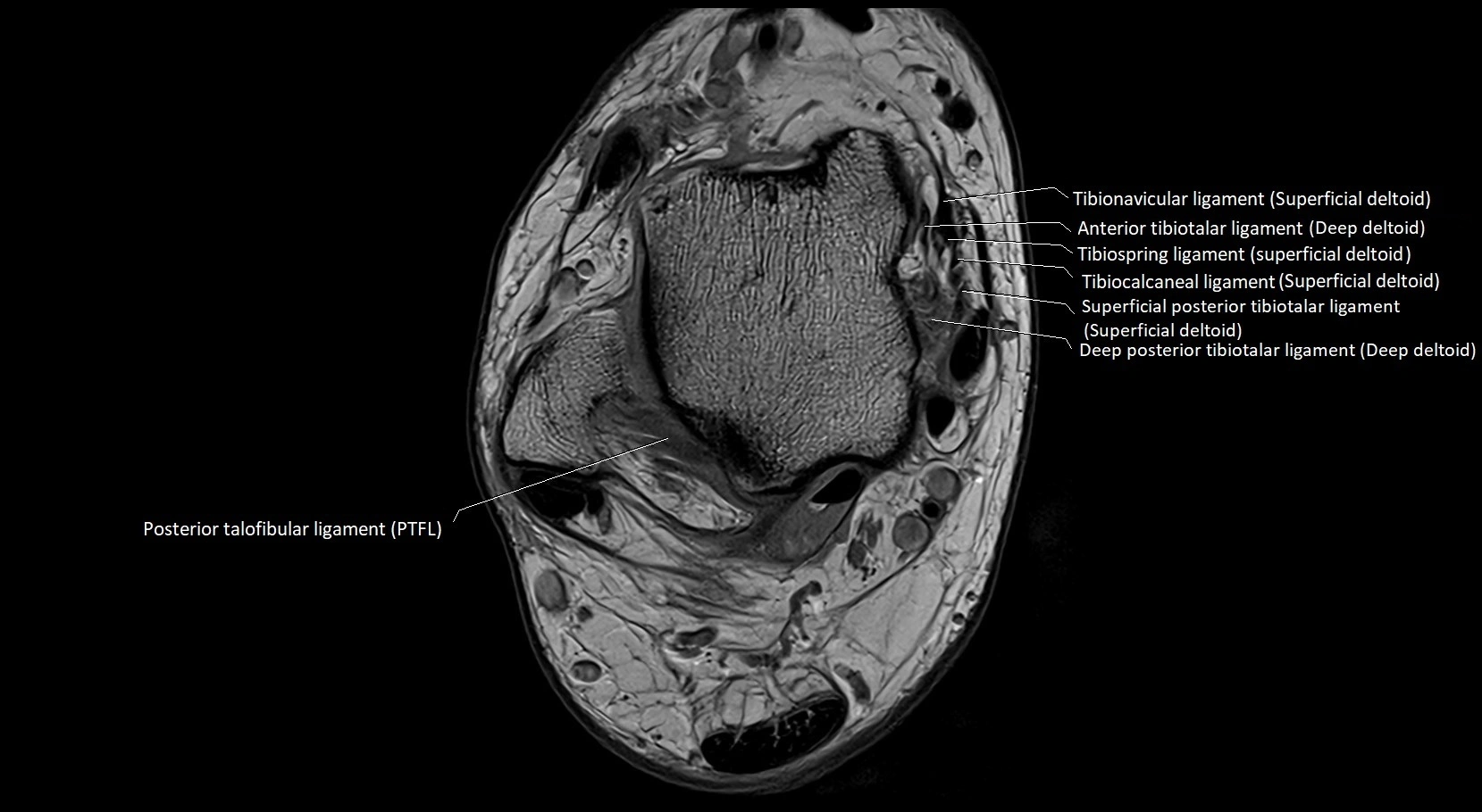 MRI ankle ligaments anatomy axial 3T image 9.webp